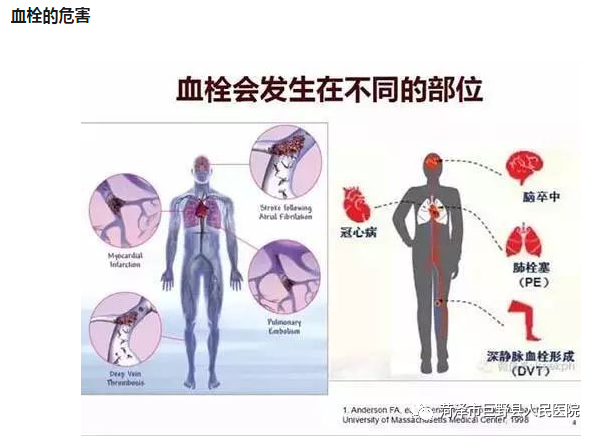 【志愿服务】巨野县人民医院举办“世界血栓日”义诊活动 - 巨野县人民医院